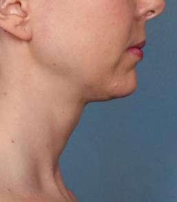 Results with KYBELLA BEFORE AFTER KYBELLA Treatment Resulted in High Patient Satisfaction 79% of patients treated with KYBELLA reported satisfaction with the appearance of their face and chin After