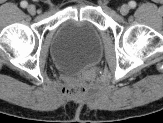 Colorectal Recurrence Equivocal CT findings 55yo M s/p