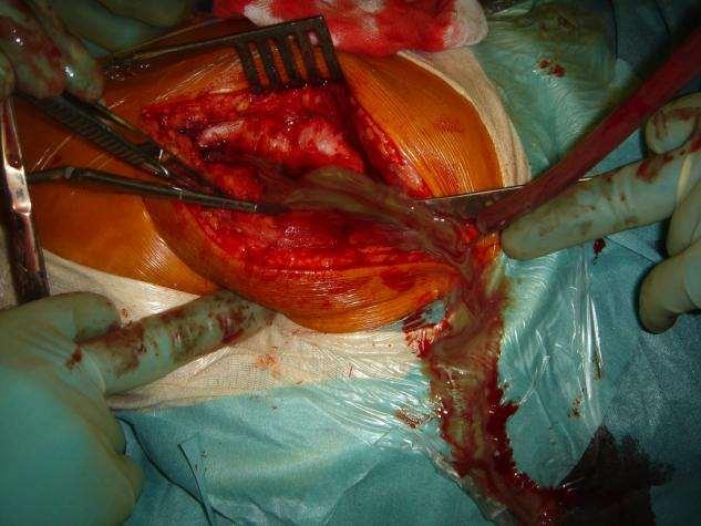 Surgical revision Incision of fascia -> pus!