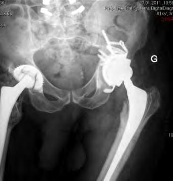 of hip prosthesis