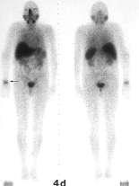 Vitamin B12 for tumor diagnosis Prostata carcinoma SPECT 4 h In-111 Adenosylcobalamin 650 μci (2.2 μg) i.v.
