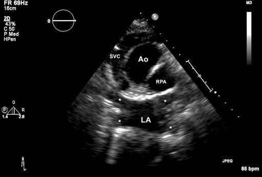 Figure 7 Suprasternal scan showing all
