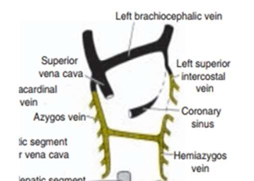 6- The superior vena cava is formed by A-The right common cardinal