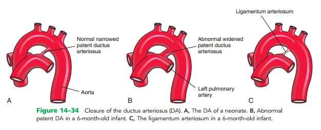 Patent ductus arteriosus (PDA) a common birth defect, occurs two to three times more frequently in females than in males Functional closure of the PDA usually occurs soon after birth; however, if it