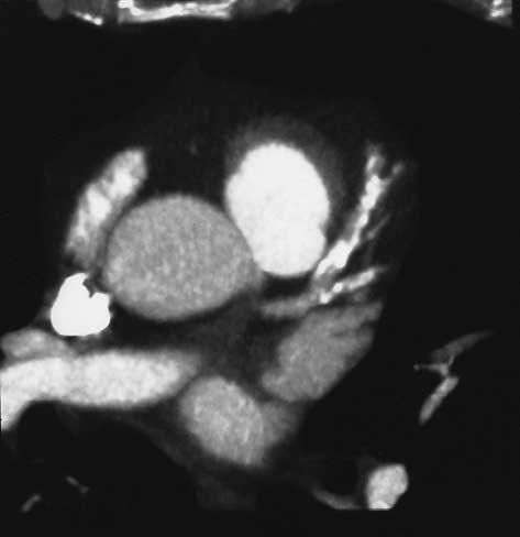 A B Figure 2. Frequently Observed Reasons for Inability to Evaluate Electron-Beam CT Images of the Coronary Arteries.