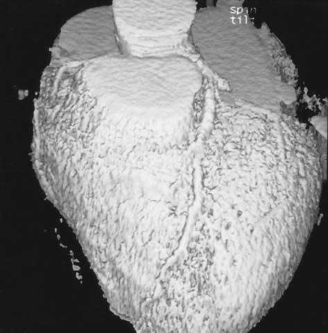 ELECTRON-BEAM COMPUTED TOMOGRAPHY TO DETECT HIGH-GRADE CORONARY-ARTERY STENOSES AND OCCLUSIONS A B Figure 3.