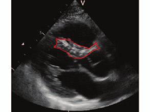 The septum is traced as indicated by the red curves. IV. DISCUSSION AND CONCLUSION The feasibility of strain compounding in echocardiography was demonstrated in this study.