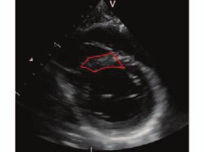 Unlike the conventional paradigm, where externally applied deformation was performed, the natural deformation of the heart was utilized in strain compounding for echocardiography.