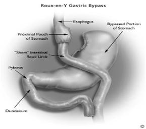 Gastric Bypass Advantages Rapid initial weight loss Minimally invasive approach is possible Longer experience in USA Minimal diet restrictions Disadvantages Cutting and stapling of stomach and bowel