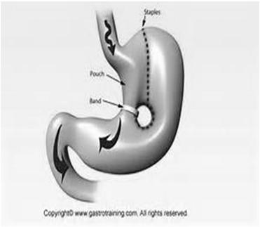 Vertical Banded Gastroplasty BPD Biliopancreatic Diversion 24 Advantages Greatest amount of initial weight loss due to the high levels of