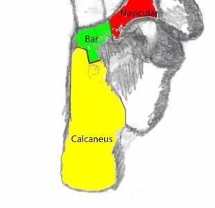 portion of the navicular bone.