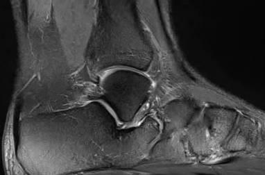 navicular with posterior elongation), the talar beak sign with a prominent beak proximal to the talonavicular joint, and marrow edema.