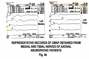 Latencies: The latencies obtained from tibial nerve recorded at abductor hallucis muscle of neuropathic patients was greater than normal subjects.