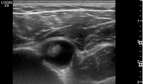 Long head biceps tendon pathology Fluid in the tendon sheath of the LHBT Fluid in the