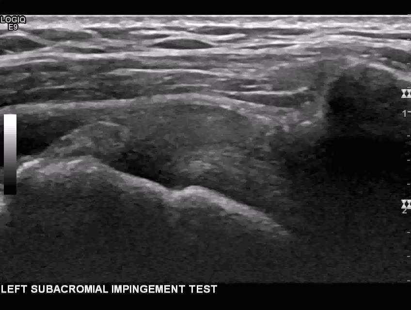 SUBACROMIAL