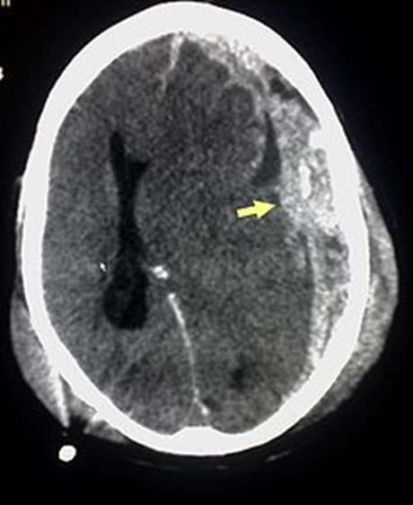 Blood clot causing increase ICP and compression of brain Three types Epidural Subdural