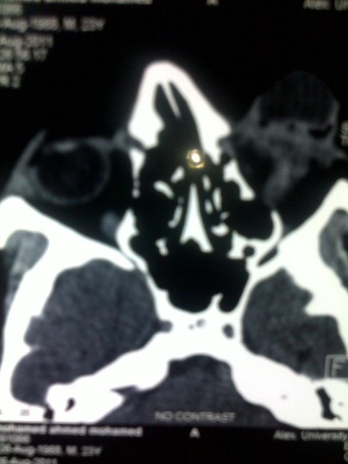 CT scan showing