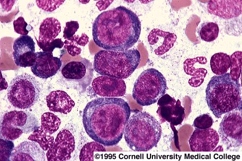 Megaloblastic Anemias Anemia characterized by the presence of large, immature, abnormal red blood cell progenitors in the