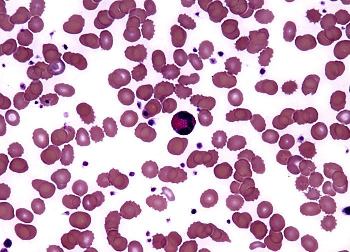 Pernicious Anemia Pernicious anemia is a type of megaloblastic anemia caused by an