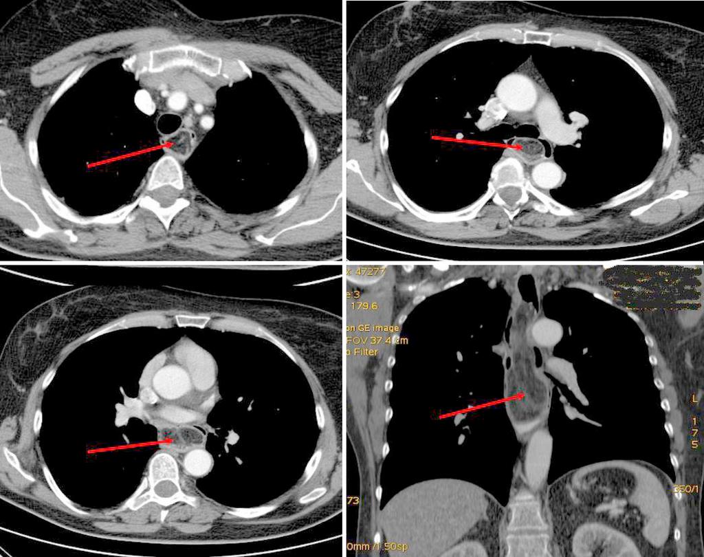 Giant esophageal lipoma: complicated surgical treatment (case report) 77 Figure 1. Computed tomography scan showing giant mass in the posterior mediastinum (arrows) Figure 2.