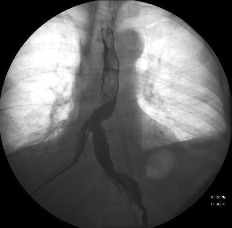 lower esophagus with leakage of the contrast (Figure 4). Decision was made to seal the leakage with a biodegradable coated stent.