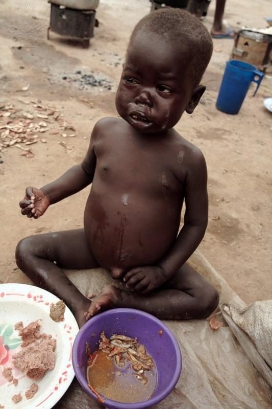 Secondary ID - Malnutrition Worldwide, protein-calorie malnutrition is the most common cause of immunodeficiency Malnutrition can result from limited access to food