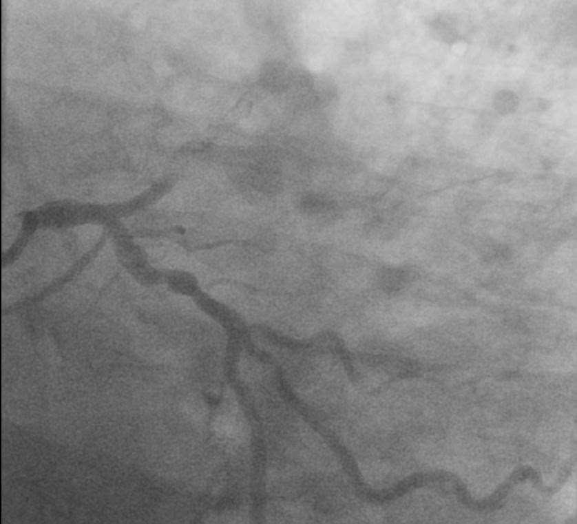 Acute In-Stent