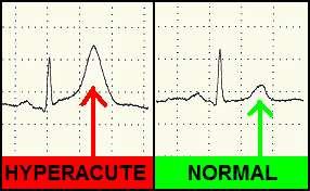 HYPERACUTE T WAVES ECG waveforms obtained just