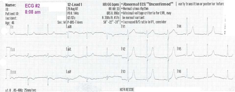 46 year old male: ECG 1 Chest pressure has returned, 5 on