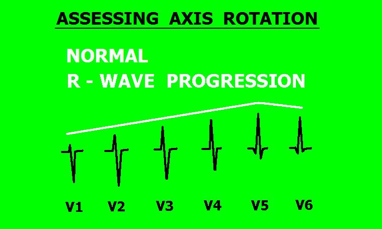 The NORMAL ECG R wave amplitude (size)
