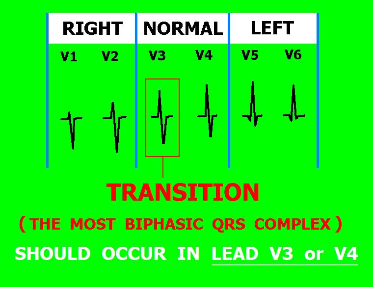 The NORMAL ECG In V3 or V4,