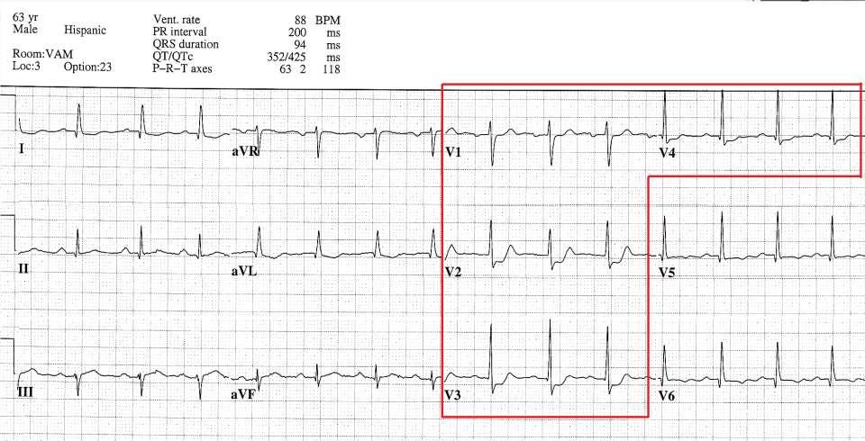 1. ECG abnormality(ies)? ST Depression V1-V4 2. Possible diagnosis?