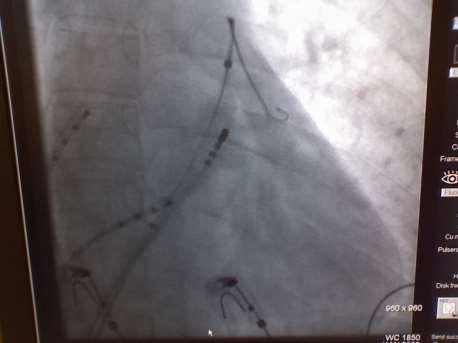 Electrophysiology Lab EP Catheters within the heart used for obtaining the