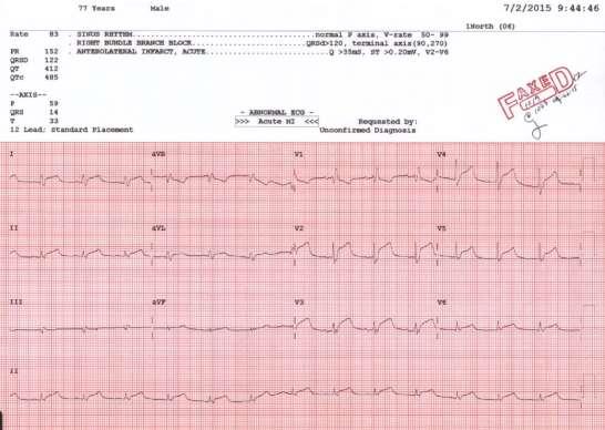 Patient: Asymptomatic Troponin normal Cardiac Cath angiography = no obstructive CAD. Discharge diagnosis: EARLY REPOLARIZATION.