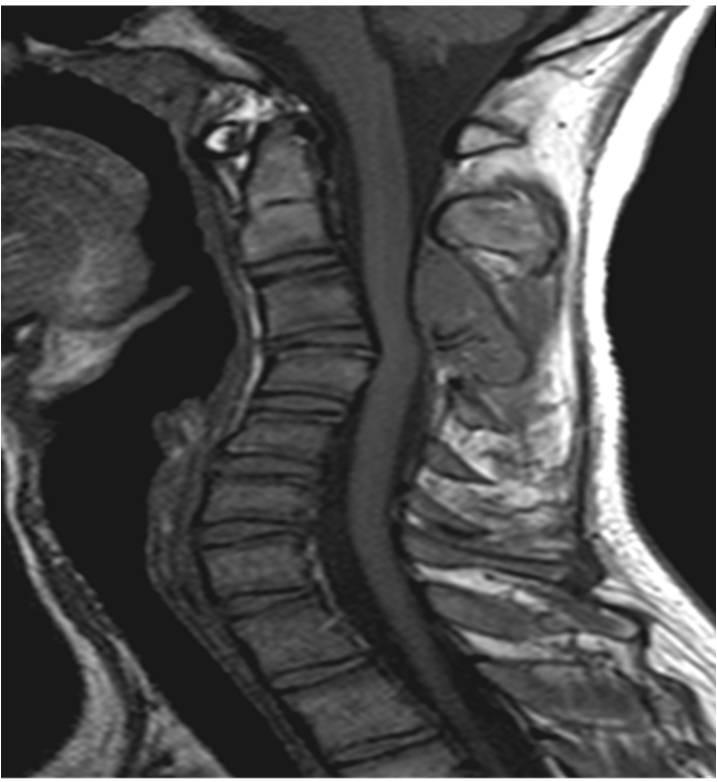 Case History K-1 (Kyung Hee University, S12-00829) A 17-year-old male presented with posterior neck pain and numbness in both upper extremities after a diving injury.