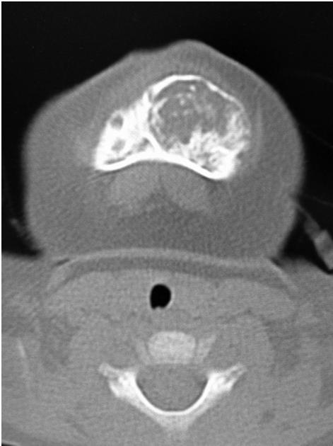 At her age of 2 months, Computed Tomography (CT) scan and Magnetic Resonance Imaging (MRI) revealed a relatively well-demarcated, expansile, osteolytic lesion in right part of the mandible, measuring
