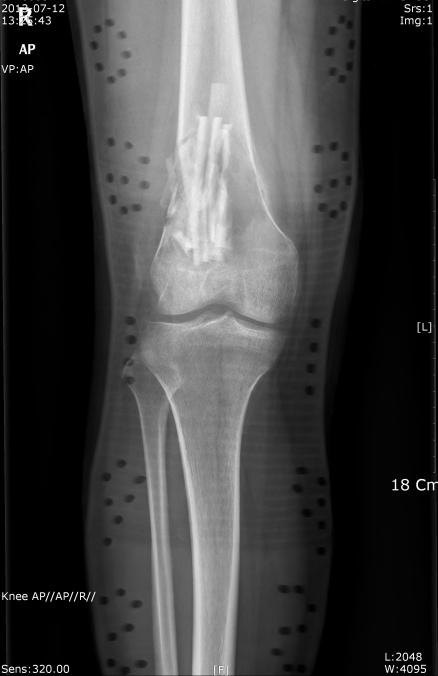 K-2 Case History A 15-year old female patient was visited Korea Cancer Center Hospital for further evaluation and management of her right knee pain.