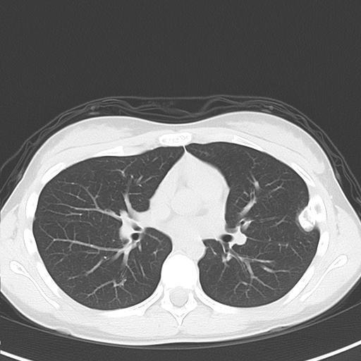 The patient had no past medical history or family history. She was asymptomatic. The tumor was not palpable.