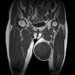 K-4 Clinical History (St. Vincent Hospital S13-16935) A 76-year-old woman presented with huge mass in the inner side of left thigh exists for 10 years.