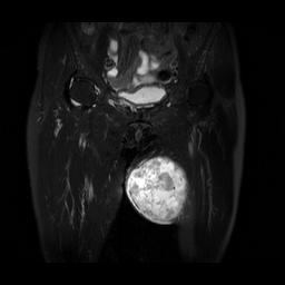 On MRI, this tumor was a large lobulated soft tissue mass confined within subcutaneous fat tissue and showed heterogenous signal intensity. Intramuscular involvement was absent.