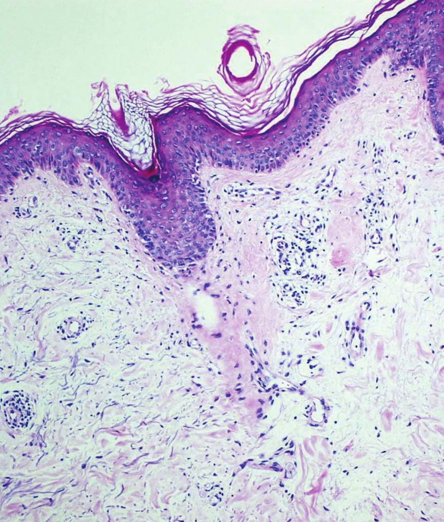3 Figure 3: Superficial perivascular dermatitis; basket-weave hyperkeratosis through the epidermis, slight atrophy, vacuolar degeneration of the basal lamina, papillary dermal oedema, and