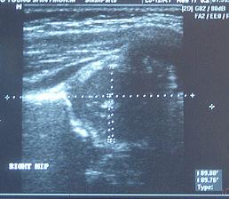 3. Congenital pelvic