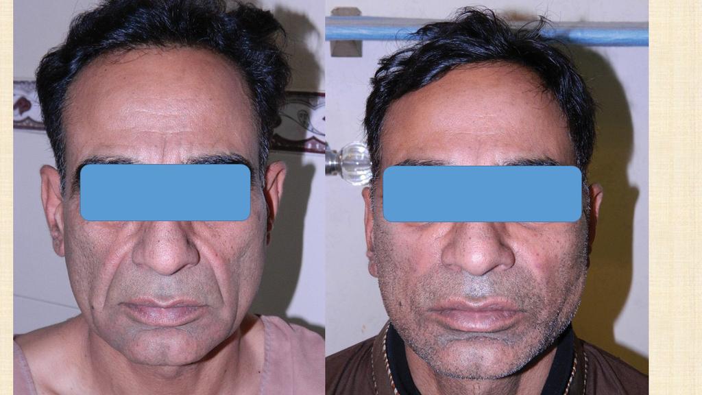 Thread facelift: Satisfaction rate among the patients using FACE-Q from 46% to 58% (15.9 to 19.4) whereas, in females, the score improved from 44% to 58% (15.6 to 19.4) (p<0.01).