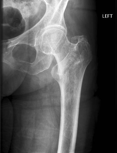 Under treatment Continued ACE inhibitors and B-blockers Ca and Vit D (v bisphosphonates) Vitamin D3 and calcium to prevent hip fractures in the elderly women.