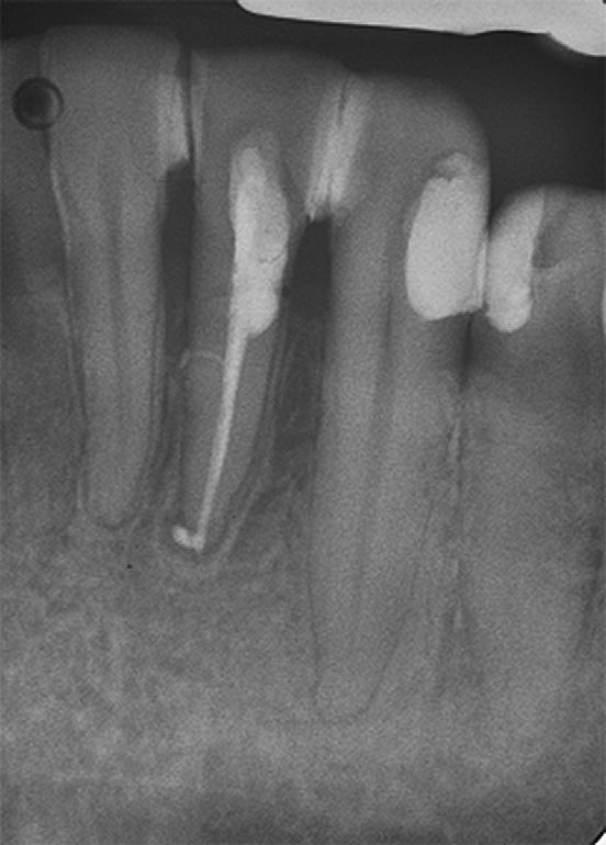 of the tooth. Significantly increased pain during palpation and abundant pus from both the canal and pocket meant that any manipulation, such as setting up a rubber dam and braces, was impossible.