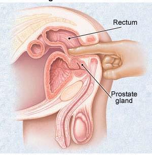 Prostate Cancer Detection Stage 1: Annual Digital Rectal Exam Your doctor will insert a gloved,