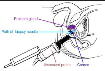 Prostate Cancer Detection Stage 3: Prostate Biopsy A thin needle is