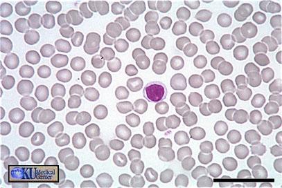 Lymphocytes Lymphocytes come in small, medium, and large varying in diameter from 6 to 18m.