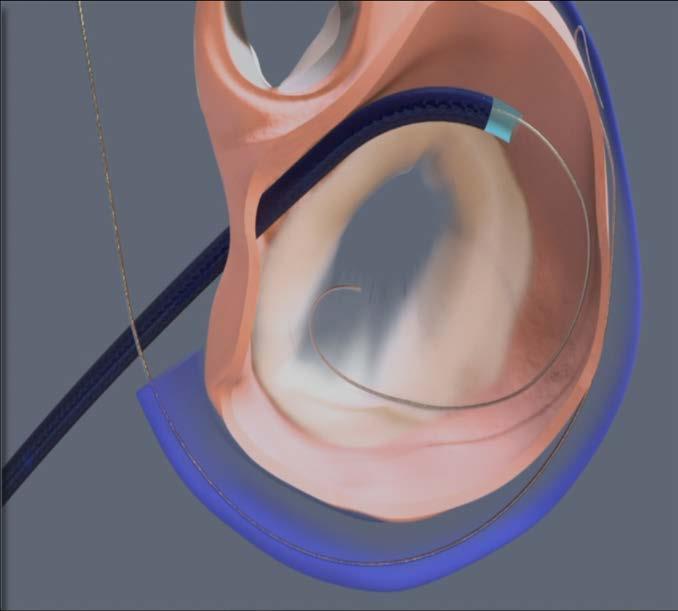 Fluoroscopic Imaging Acutely Reversible or Removable 12 Fr