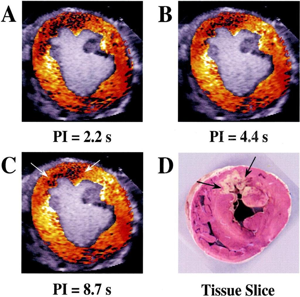 Risk area and perfusion defect size in a dog with coronary occlusion